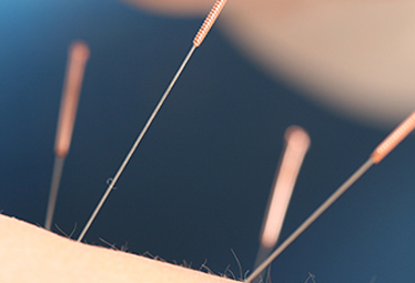 Les bienfaits de l'acupuncture