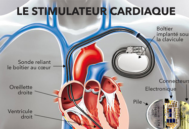 Pourquoi les aimants sont déconseillés aux porteurs de pacemaker ?