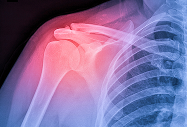 Zoom sur la tendinopathie de la coiffe des rotateurs : une pathologie symbolique ?