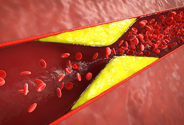 Les maladies cardio-vasculaires